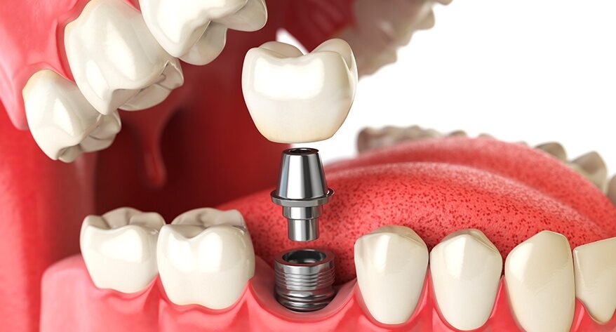 What is a Dental Implant?