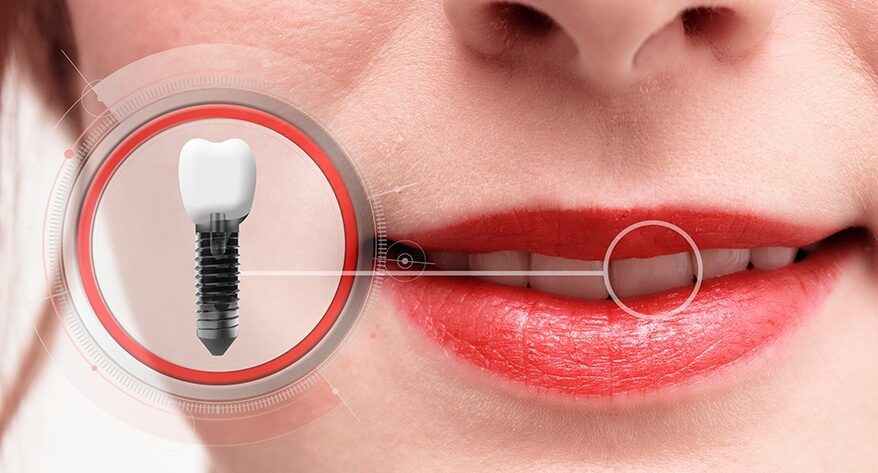 Indications of Dental Implants