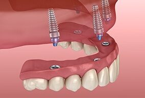 All-on-4/Teeth-in-a-Day