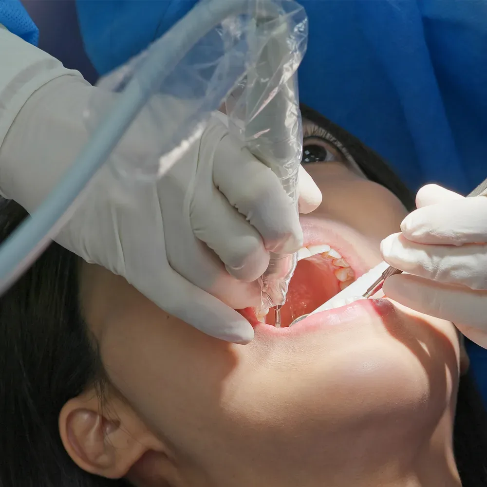 Root canal therapy procedure
