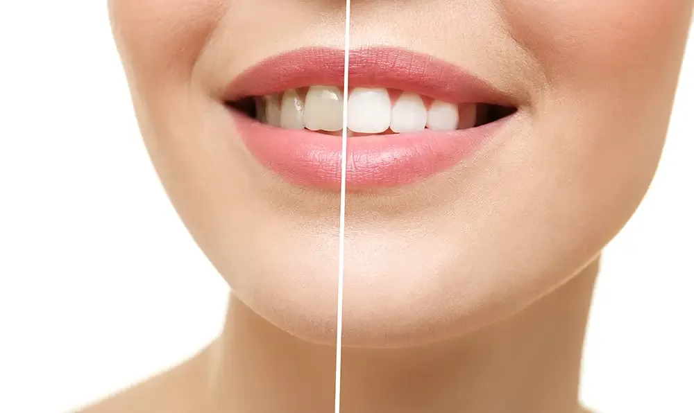Teeth whitening results