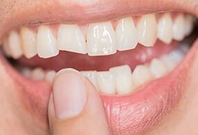 Chipped or Broken Tooth