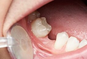 Knocked-Out Tooth