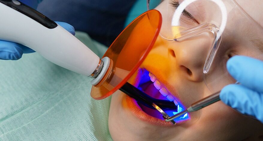 Dental sealants for children